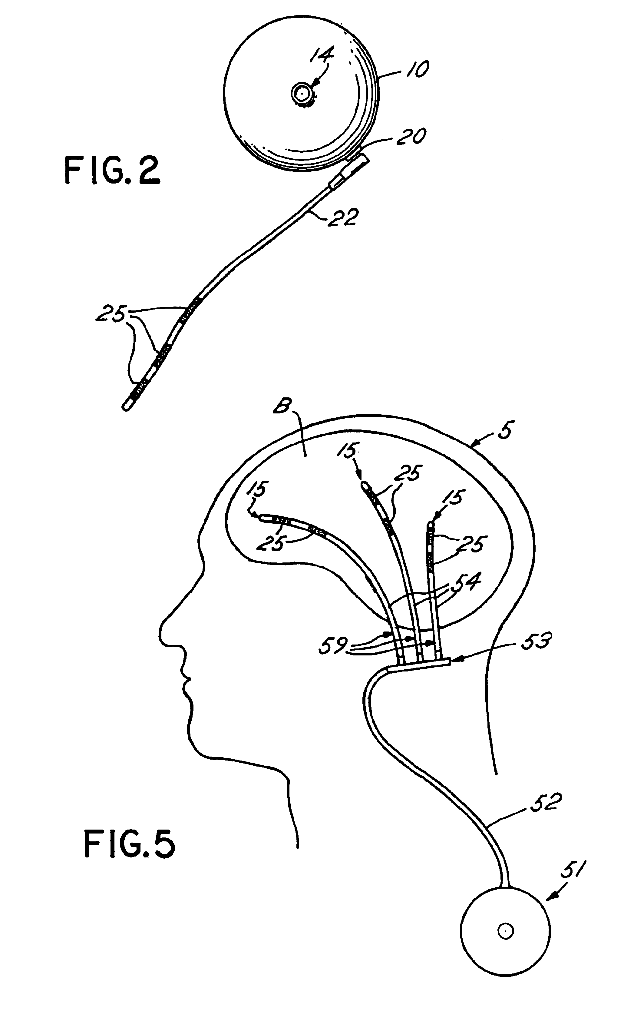Method for convection enhanced delivery catheter to treat brain and other tumors