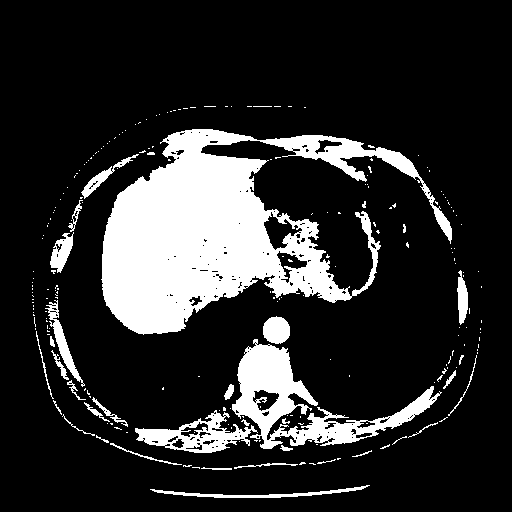 Lossless compression method used for chest computed tomography radiological image