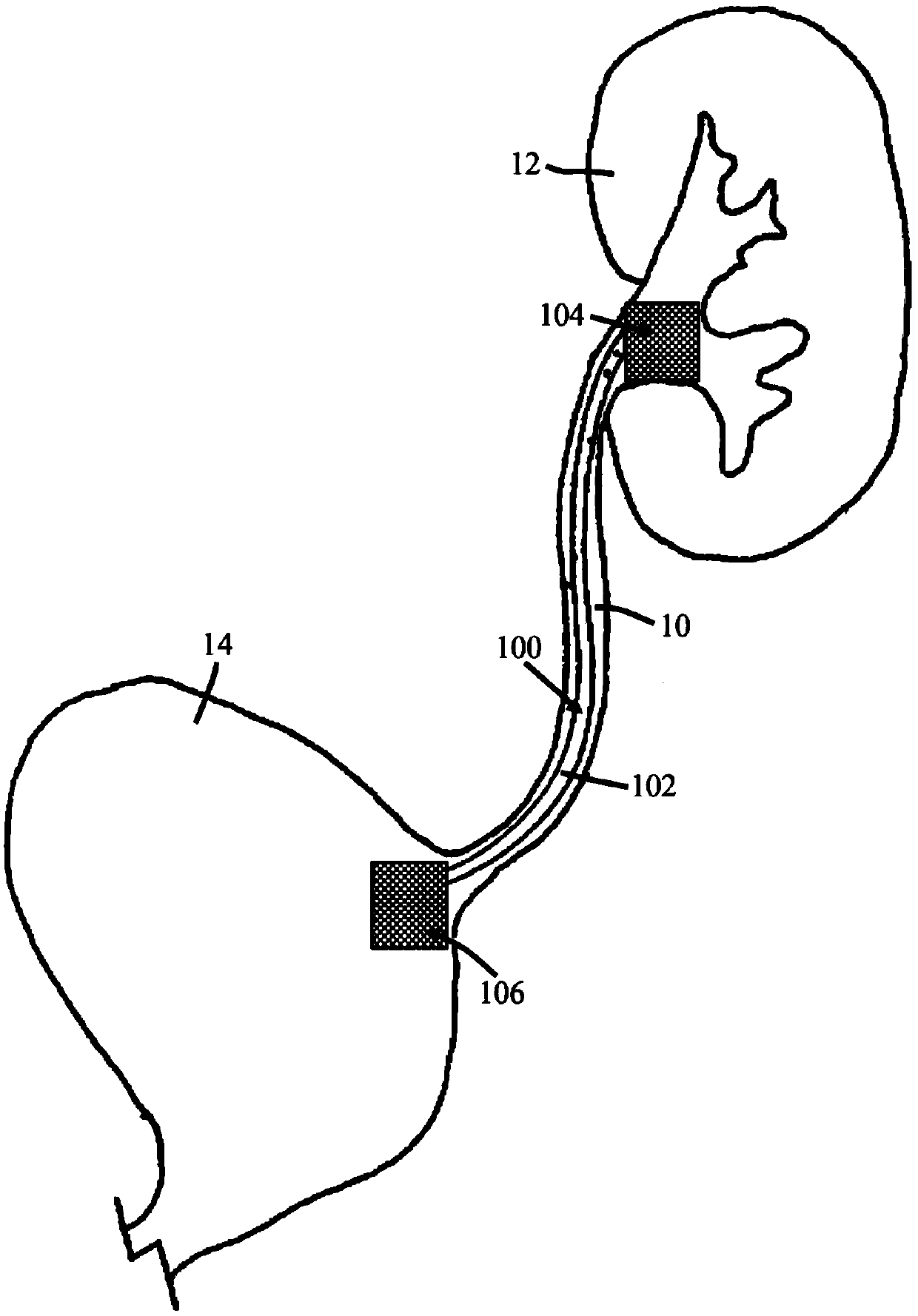 Ureteral stent