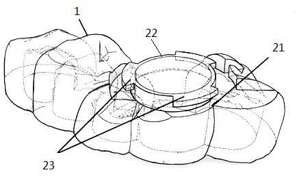 Laser-based three-dimensional positioning and guiding device for root canal therapy dental pulp opening passage