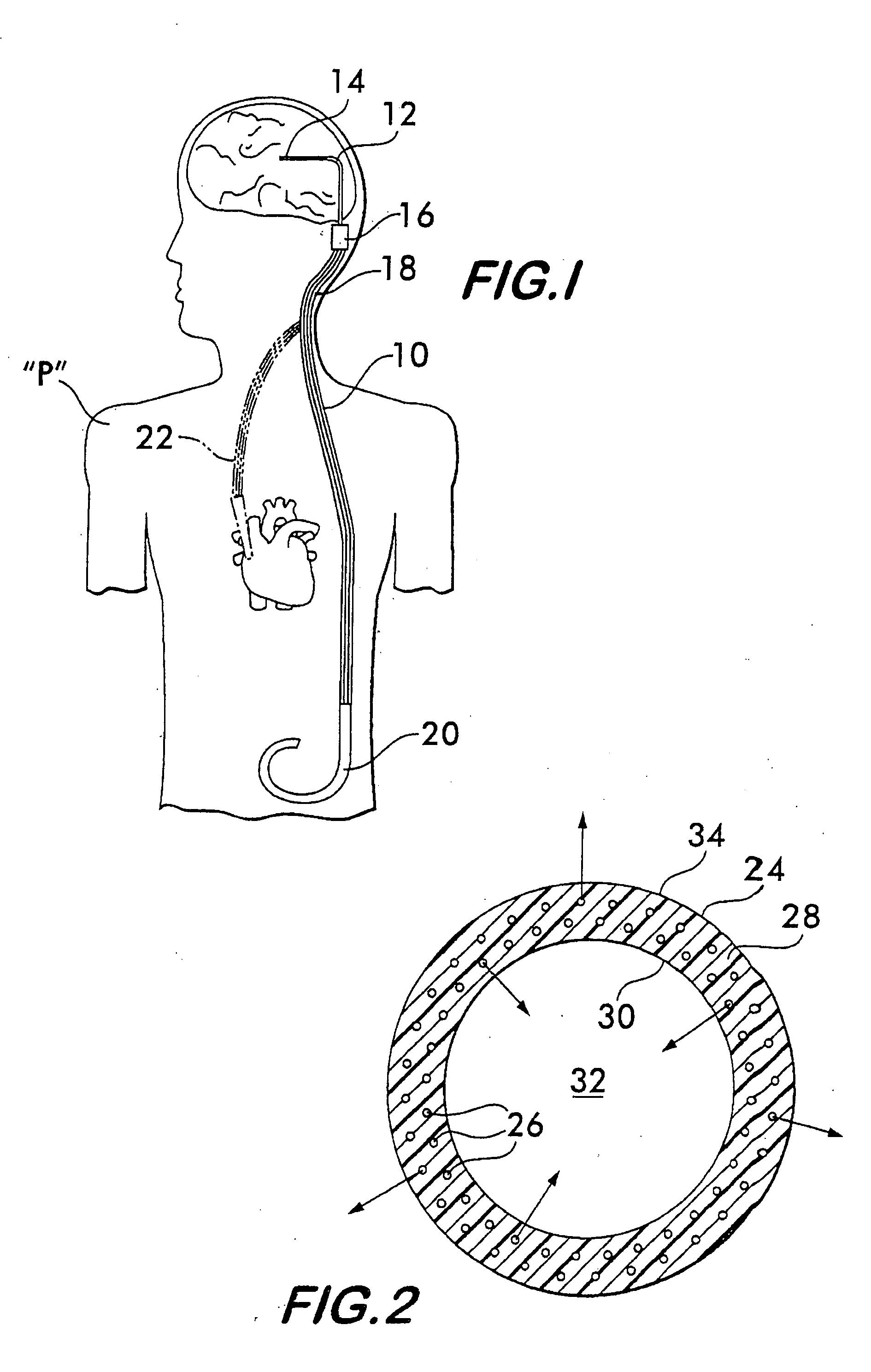 Implantable shunt or catheter enabling gradual delivery of therapeutic agents