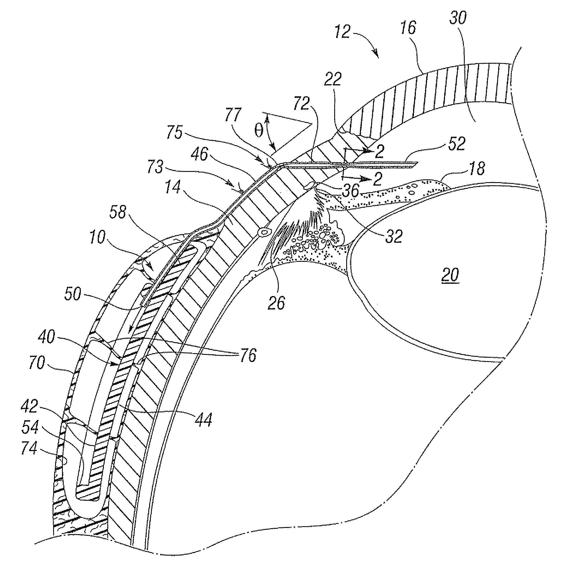 Glaucoma drainage shunts and methods of use