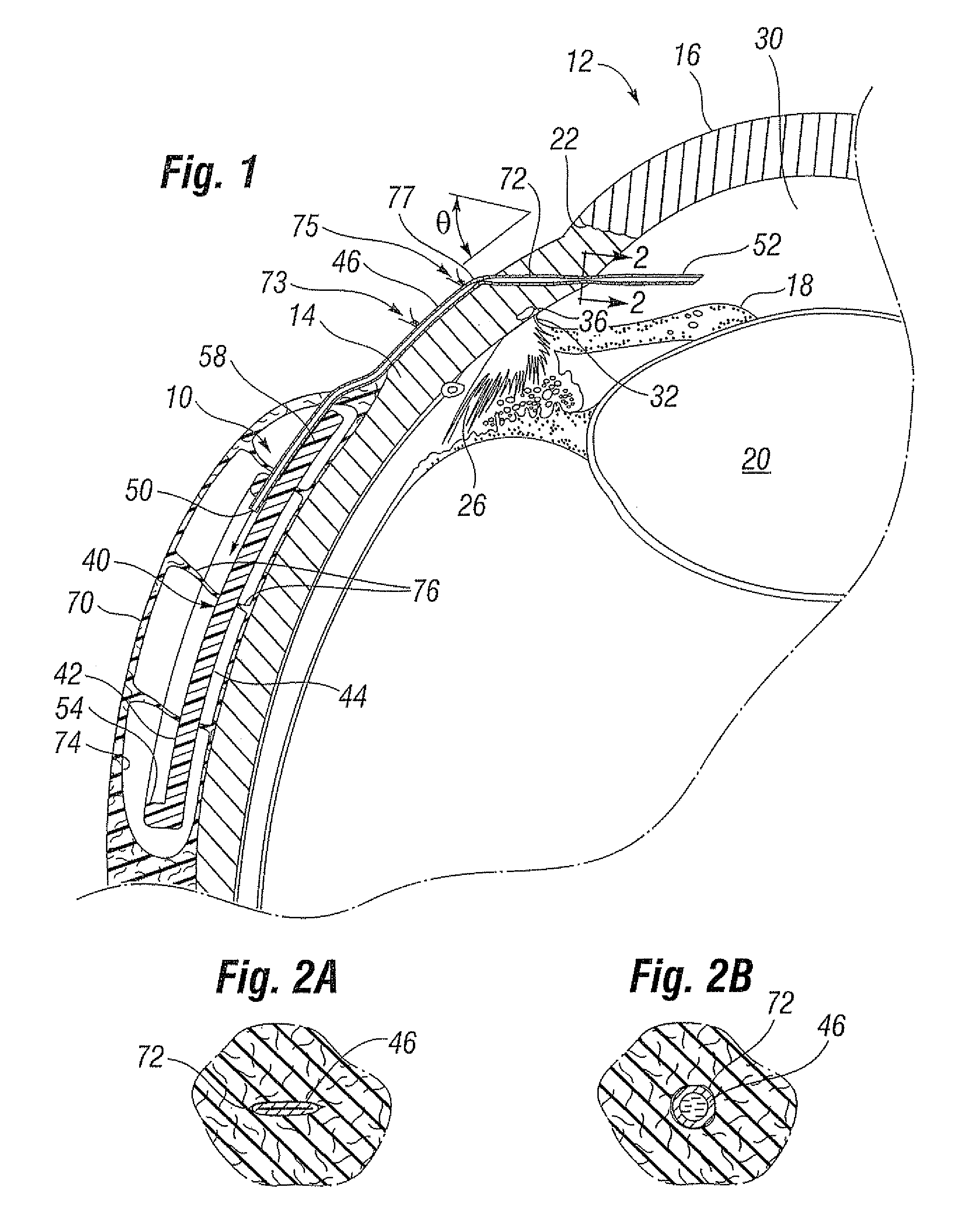 Glaucoma drainage shunts and methods of use