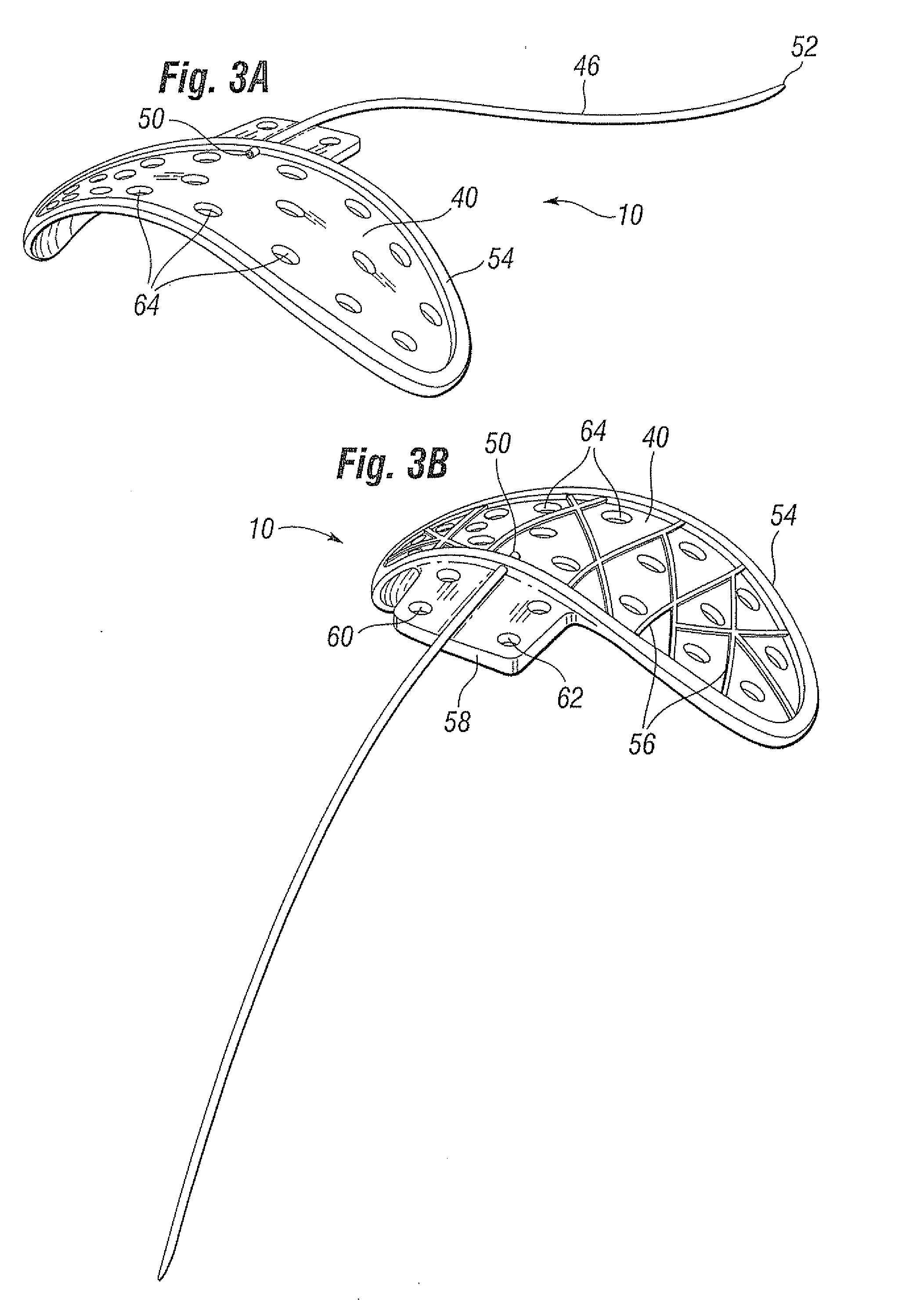 Glaucoma drainage shunts and methods of use