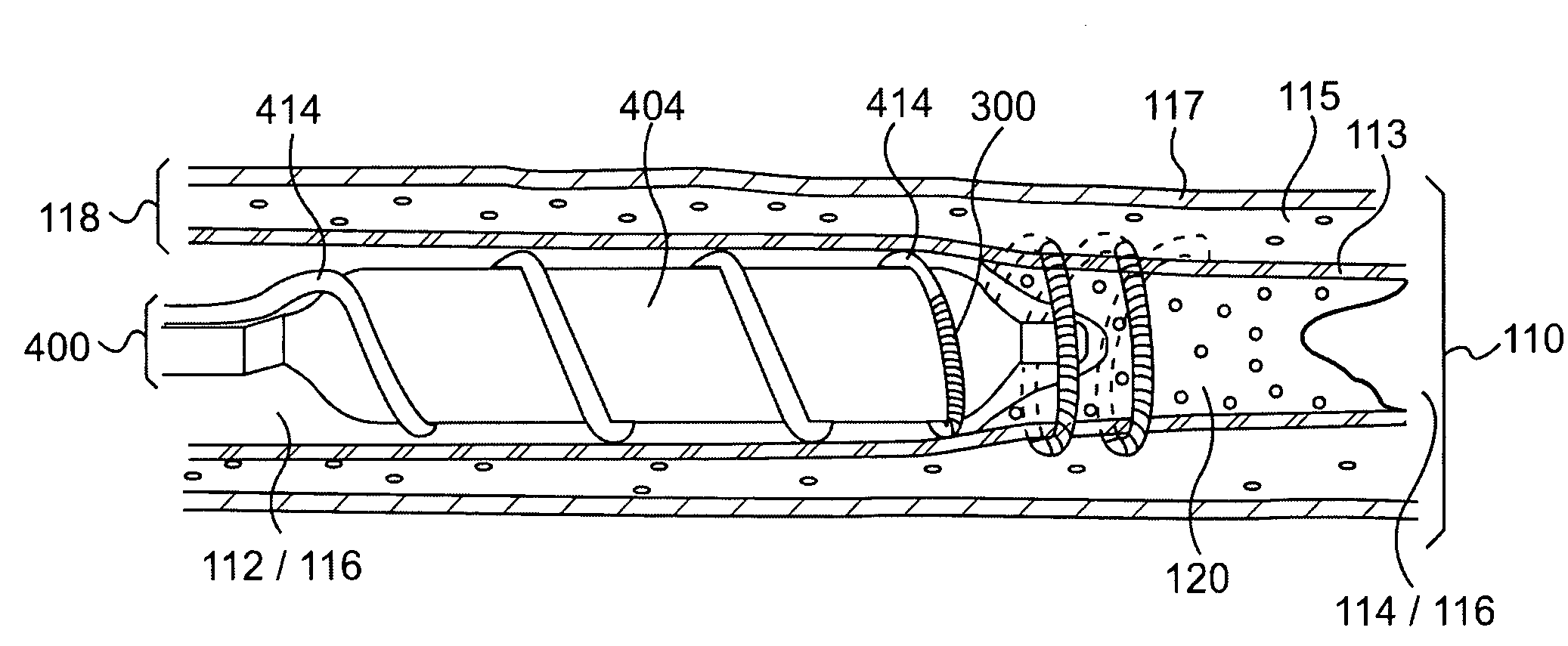 Endovascular devices and methods for exploiting intramural space