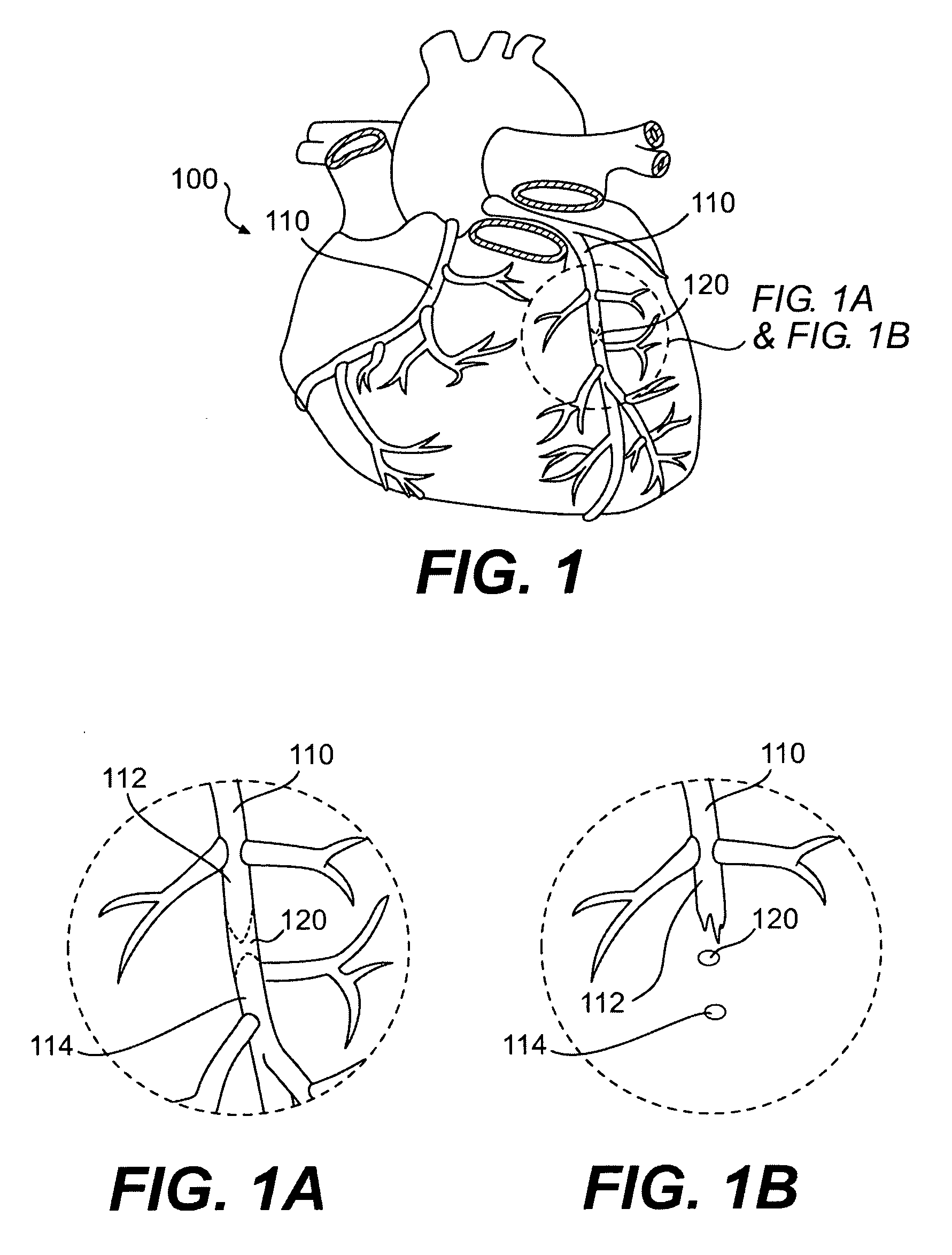 Endovascular devices and methods for exploiting intramural space