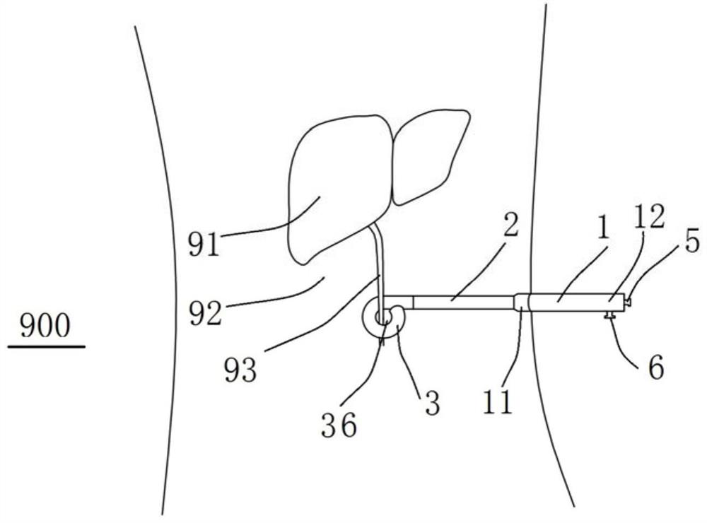 Visual visceral canal flow quantitative monitoring and control device