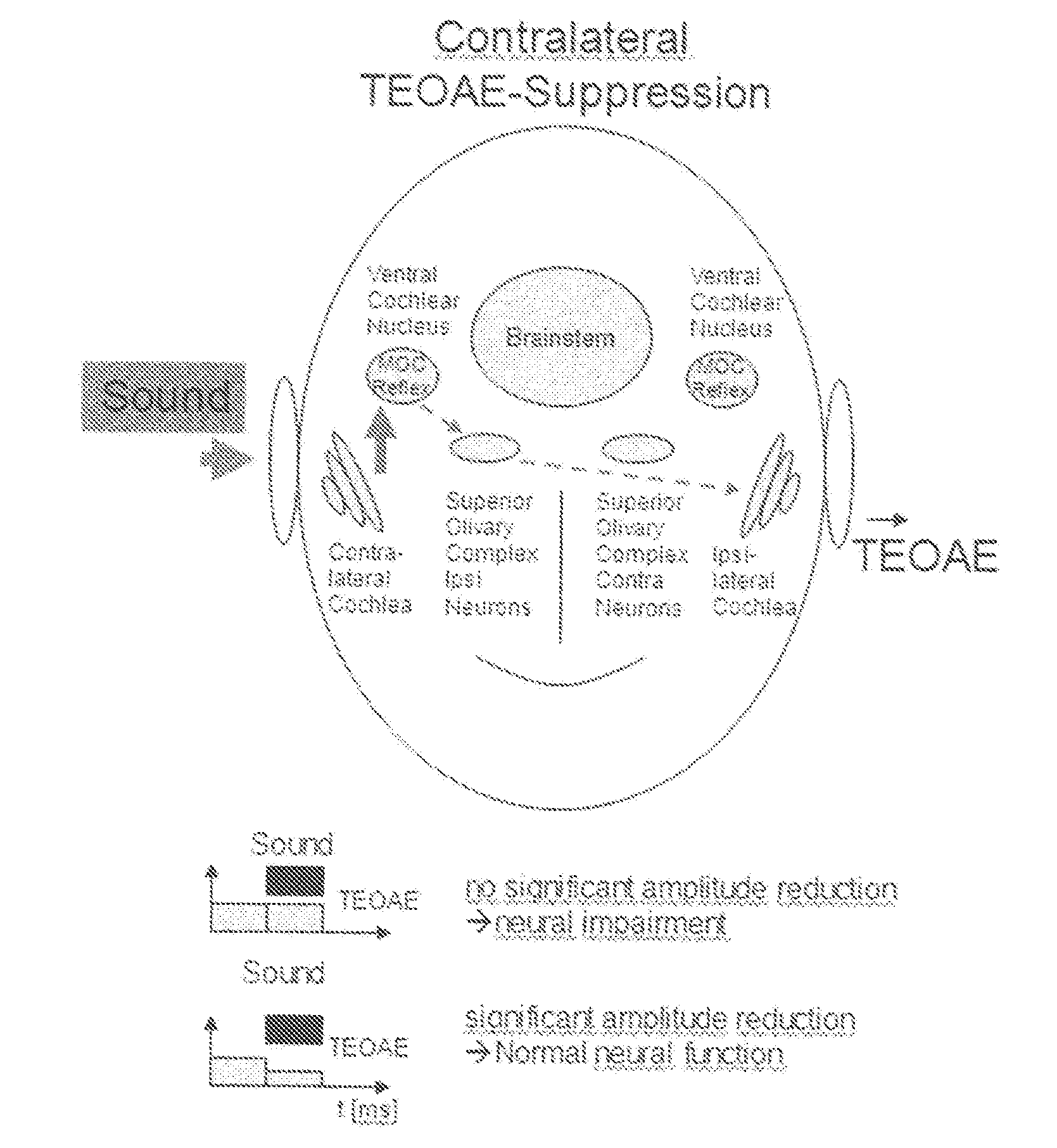 Method and Apparatus for Automated Detection of Suppression of TEOAE by Contralateral Acoustic Stimulation