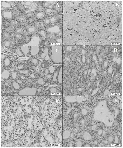 Application of yellow sole b in preparation of medicine for treating nodular goiter