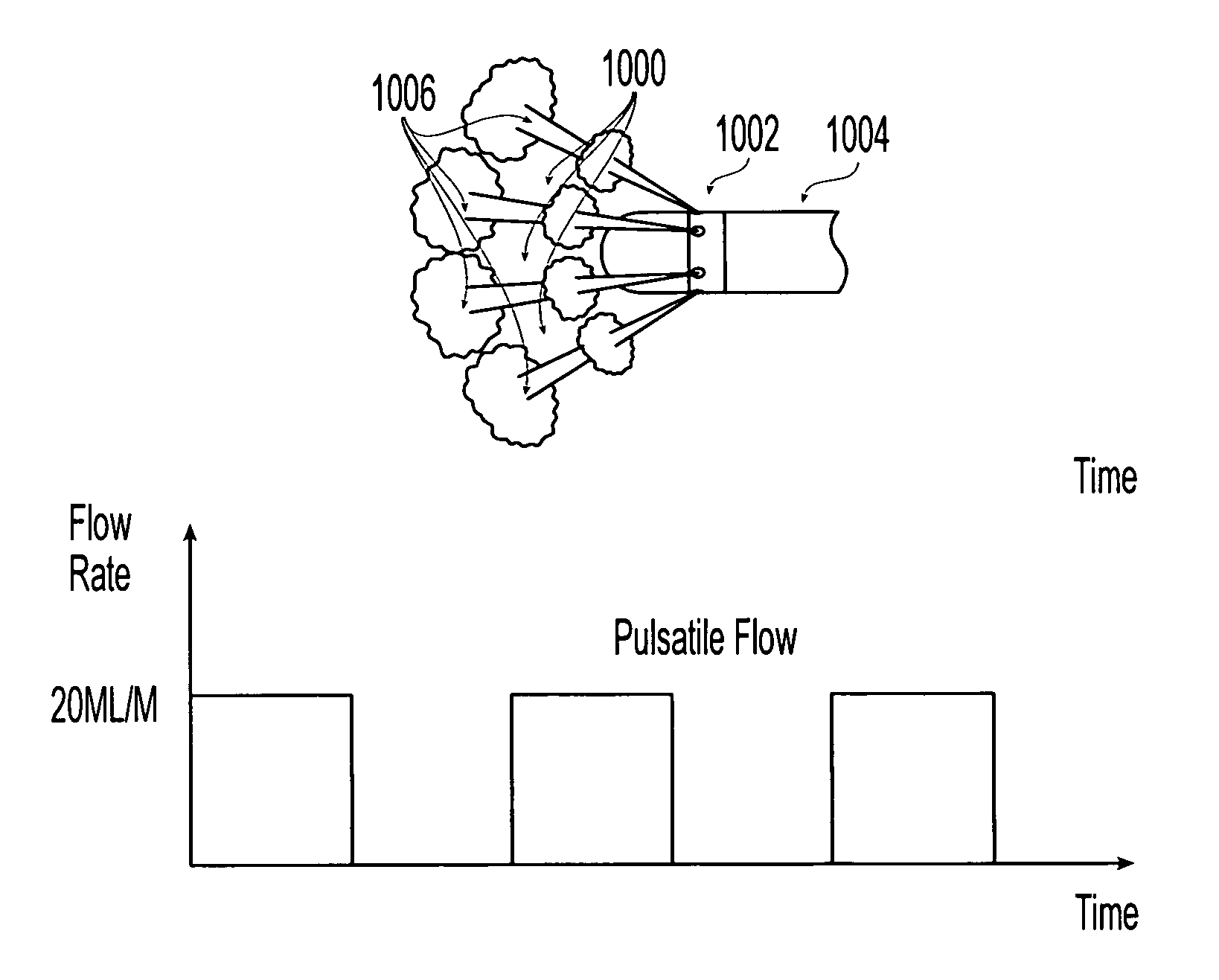 Irrigated ablation catheter system with pulsatile flow to prevent thrombus