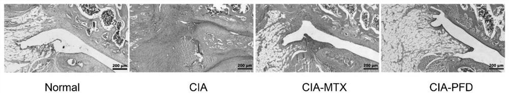 Application of pirfenidone to preparation of medicine for preventing and treating rheumatoid arthritis