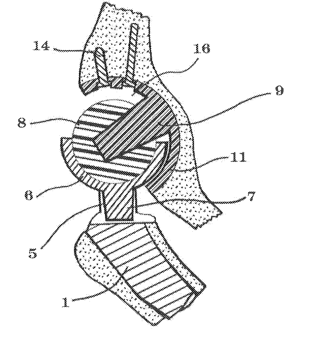 Interlocking Reverse Hip and Revision Prosthesis