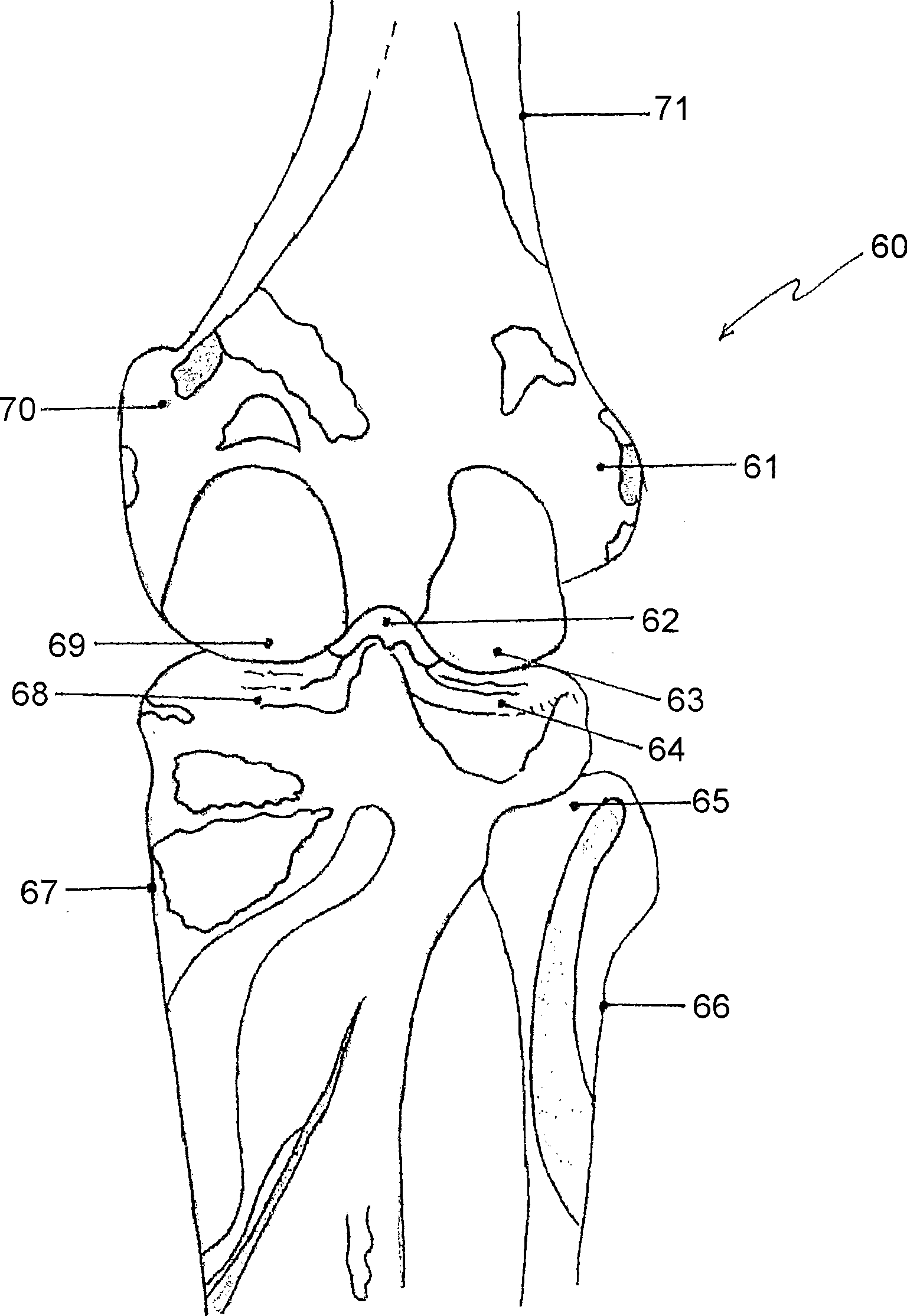 Knee joint prosthesis