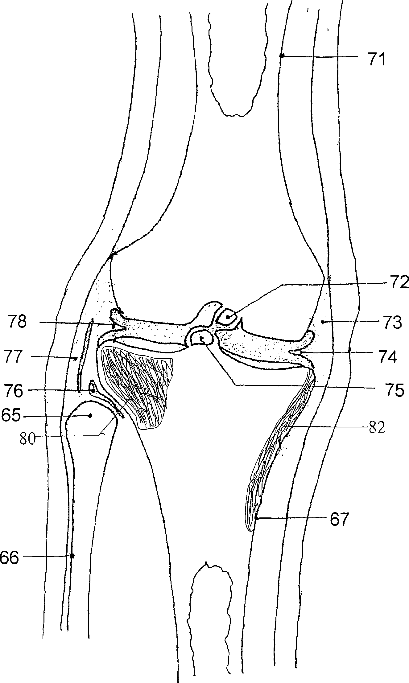 Knee joint prosthesis