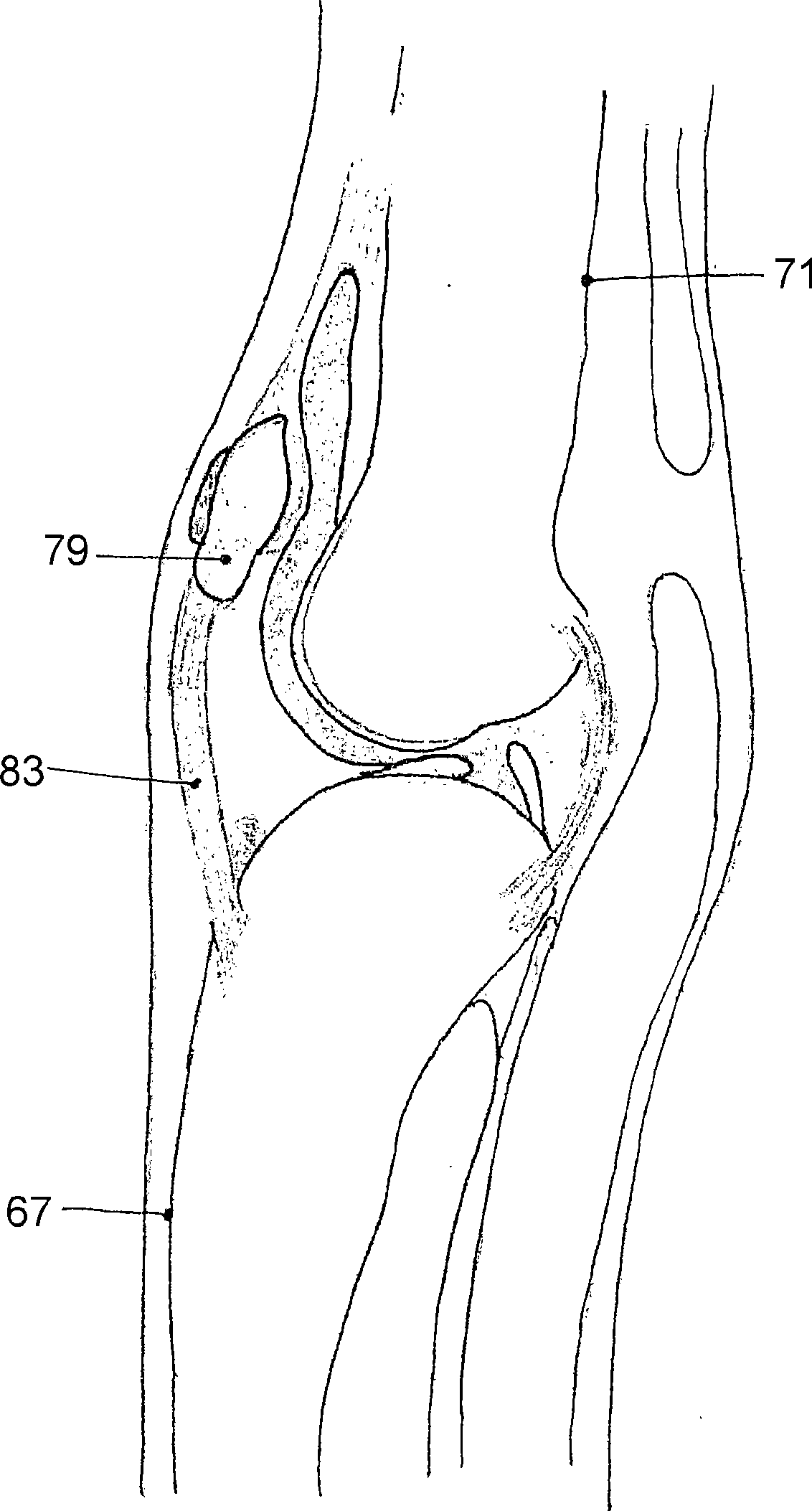 Knee joint prosthesis