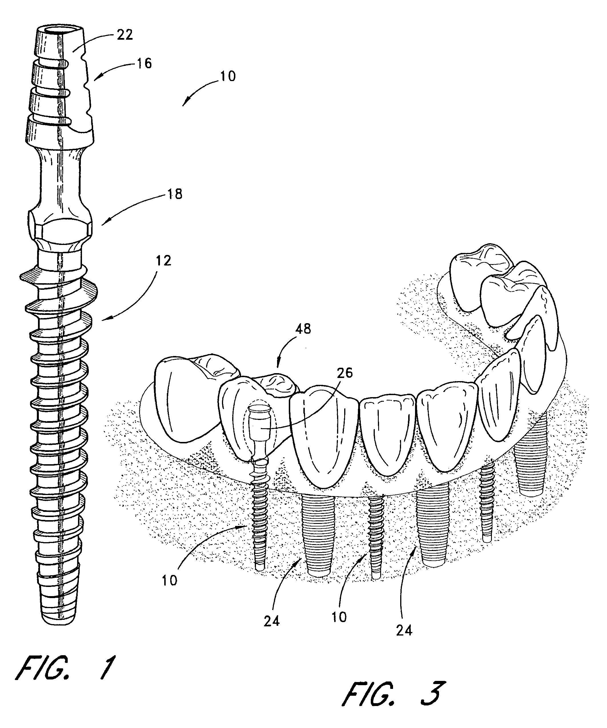 Immediate provisional implant