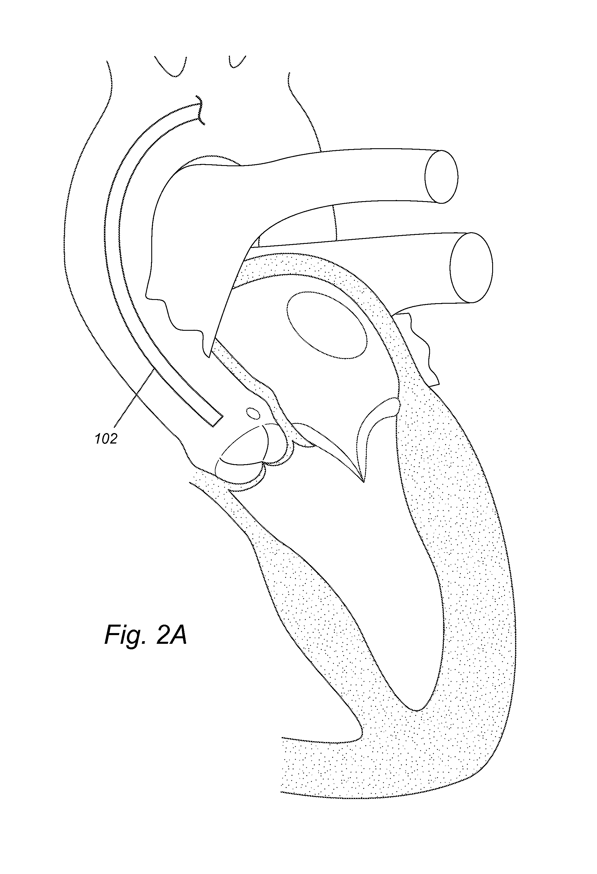 Pigtail for optimal aortic valvular complex imaging and alignment