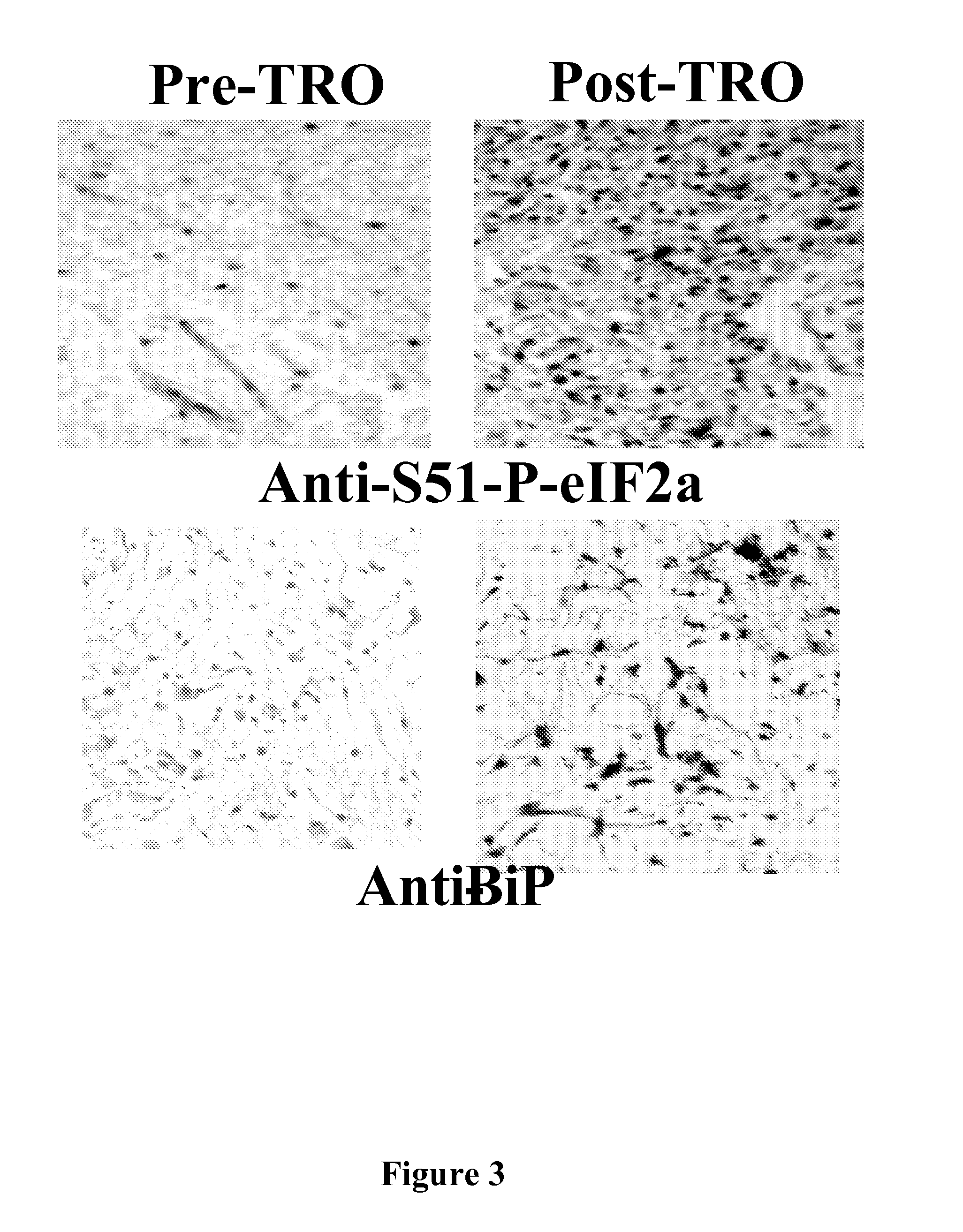 DETECTION OF PHOSPHORYLATED eIF2-alpha AS A DIAGNOSTIC TEST FOR EFFICACY AND SENSITIVITY OF TRANSLATION INITIATION INHIBITORS IN THE TREATMENT OF CANCER AND OTHER PROLIFERATIVE DISEASES