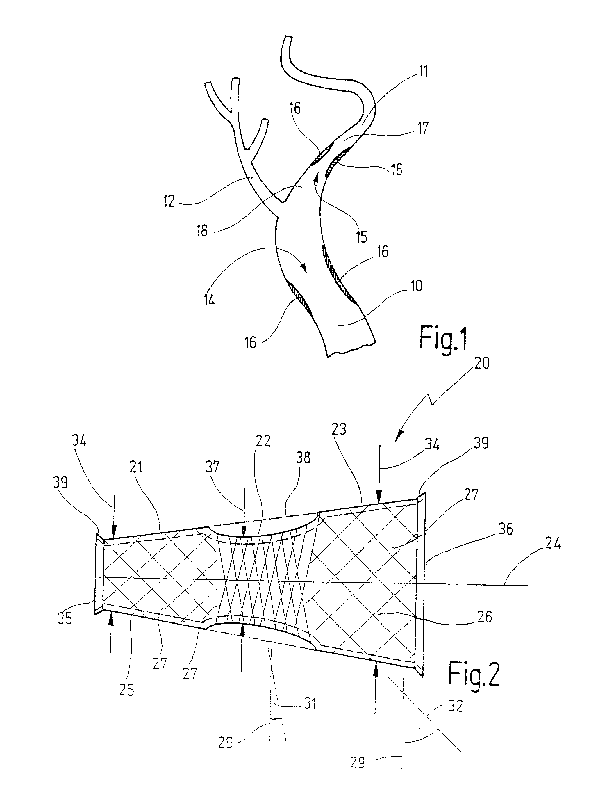 Braided stent to be implanted in a blood vessel