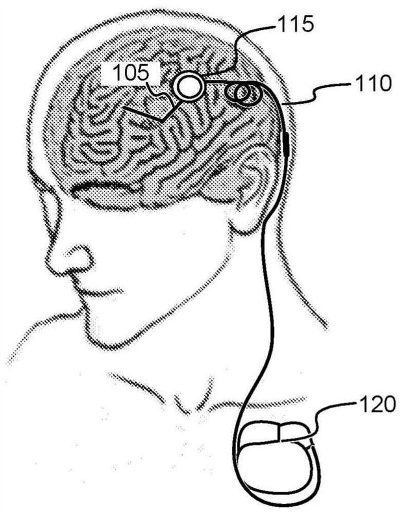 Stimulation system with monolithic-lead component connected to skull mount package