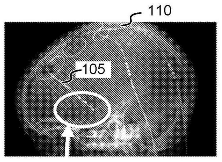 Stimulation system with monolithic-lead component connected to skull mount package