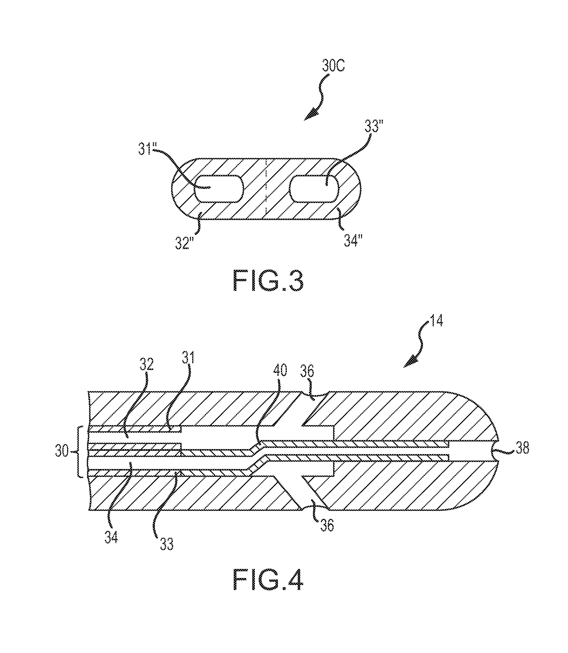 Irrigated Catheter Employing Multi-Lumenal Irrigation Tubing