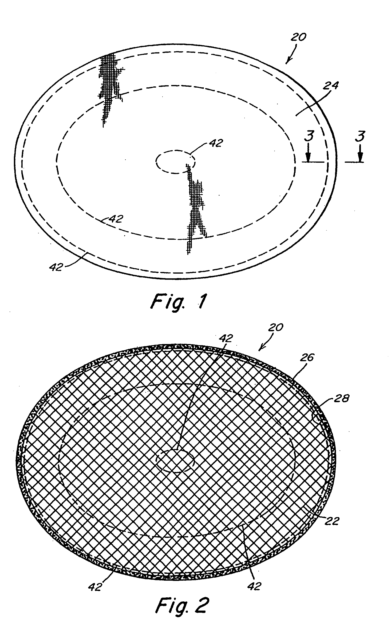 Implantable prosthesis