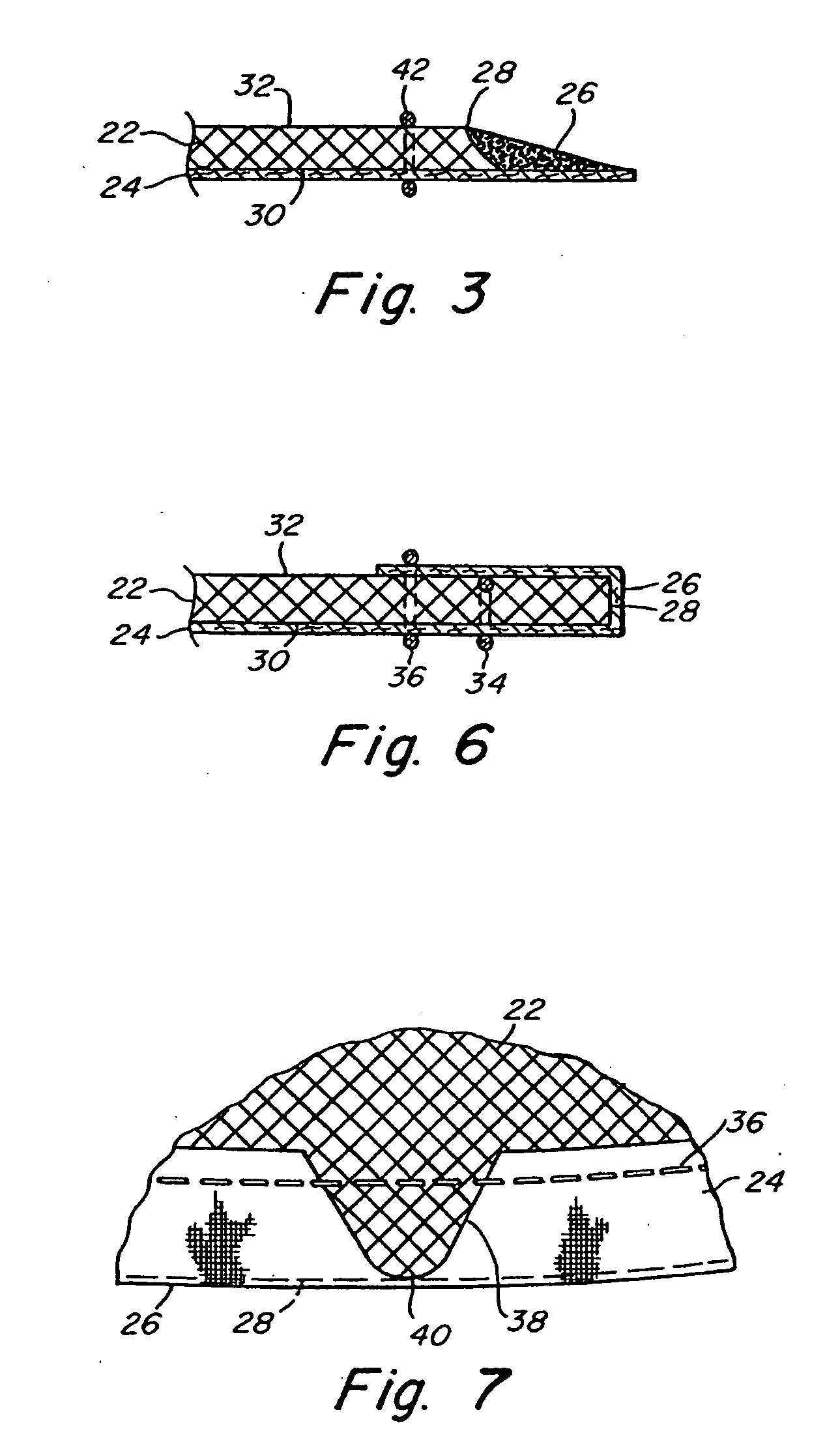 Implantable prosthesis