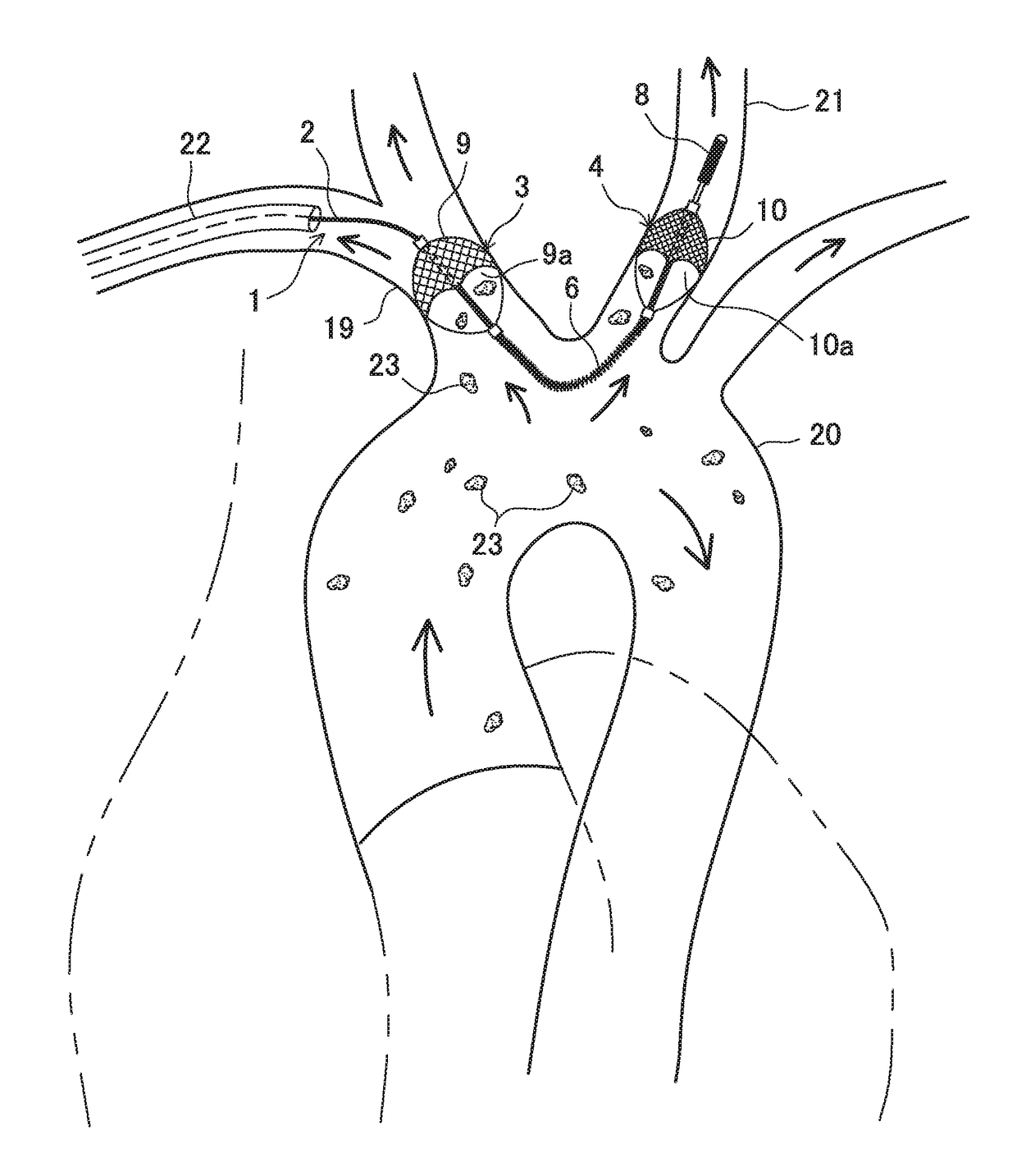 Emboli capture device