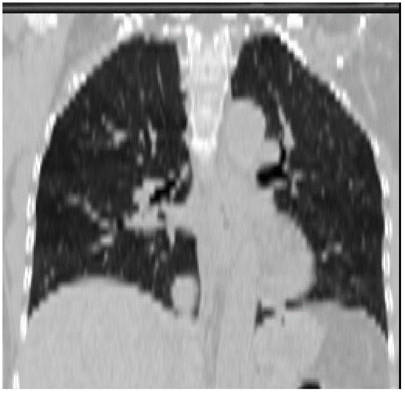 Four-dimensional-computed tomography (4D-CT) image data interlayer interpolation method for lung