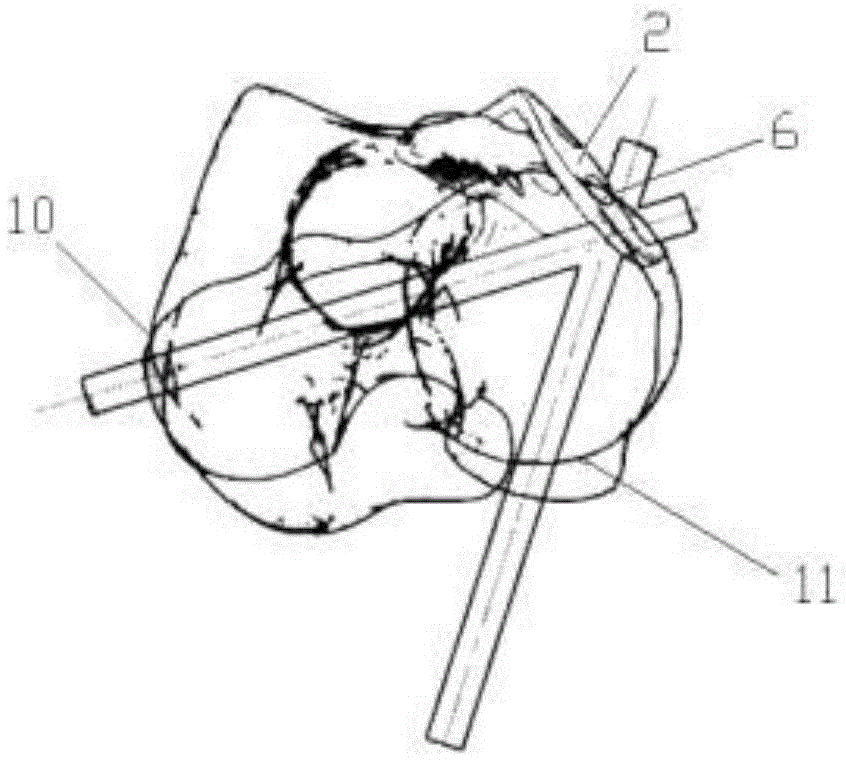 Bone plate implanted from front inner side of distal femur