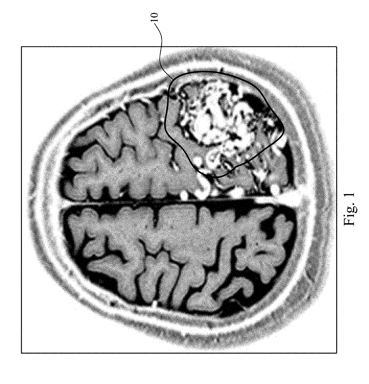 Magnetic resonance image analysis method and method for evaluating the risks of radiotherapy