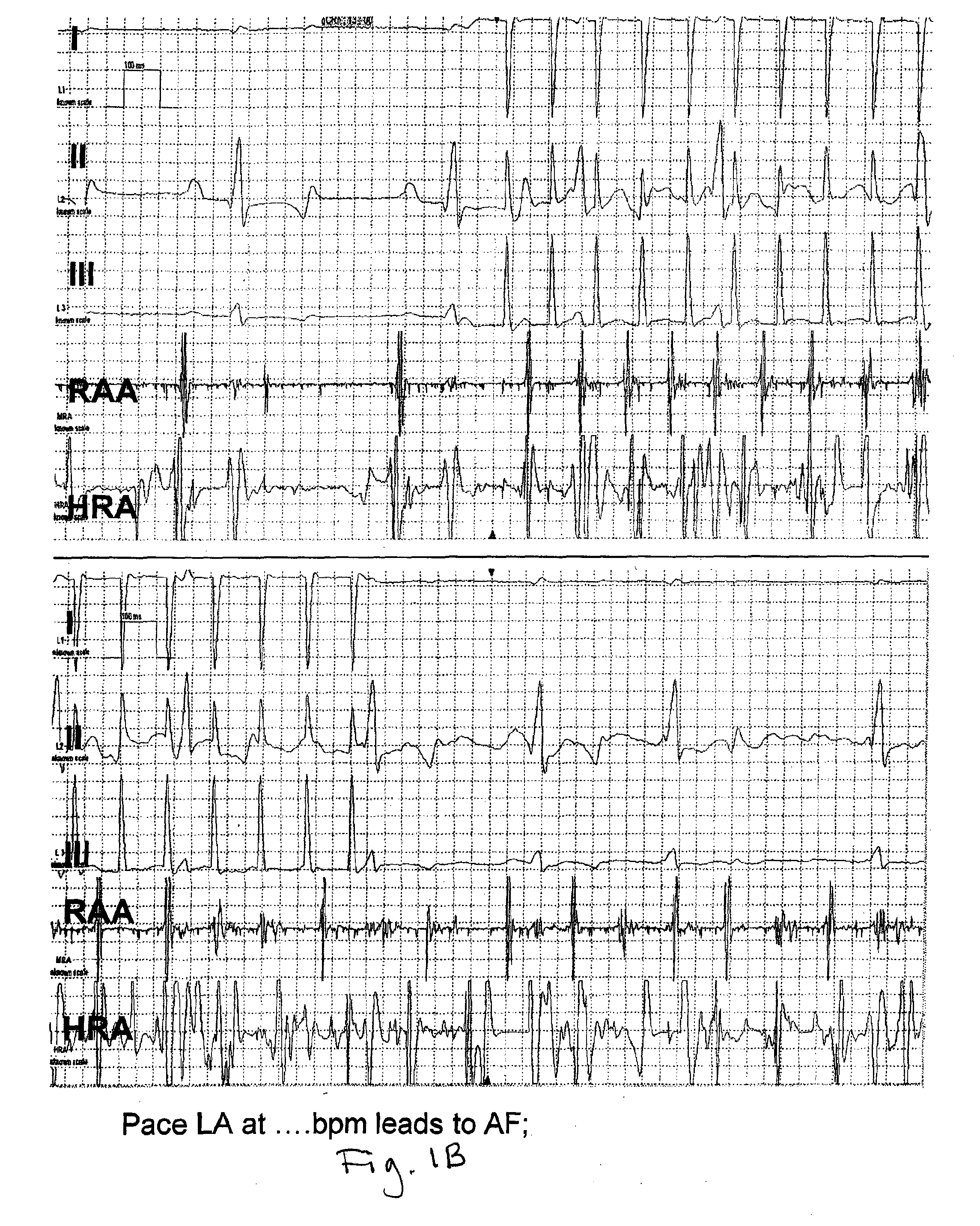 Methods and compositions to treat arrhythmias