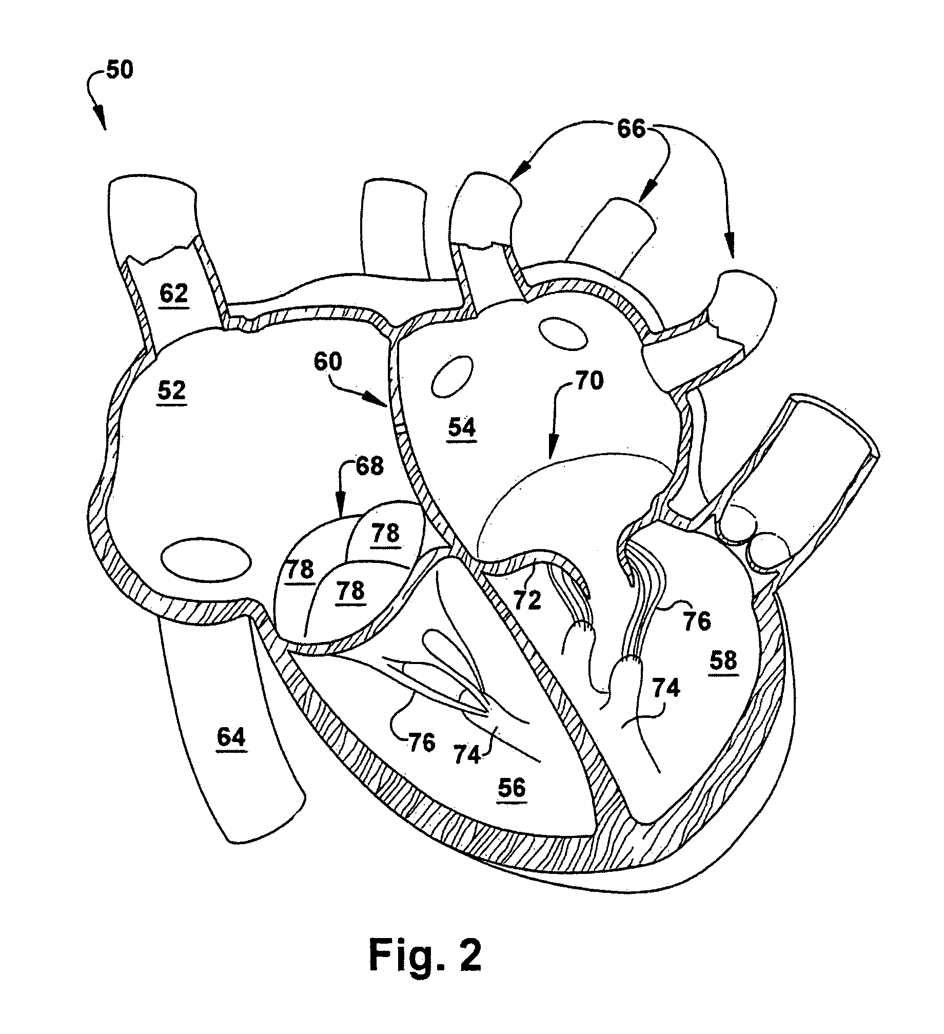 Method for implanting a cardiovascular valve