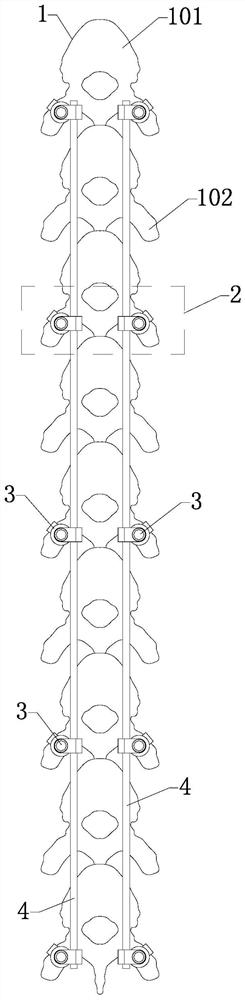 Vertebral body universal reducer used in orthopedic spine surgery