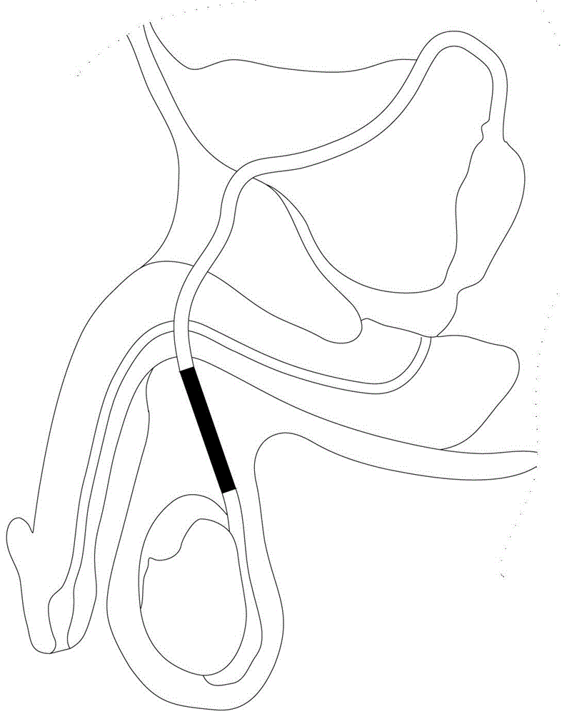 Special-shaped anti-dropping seminiferous duct sterilization apparatus