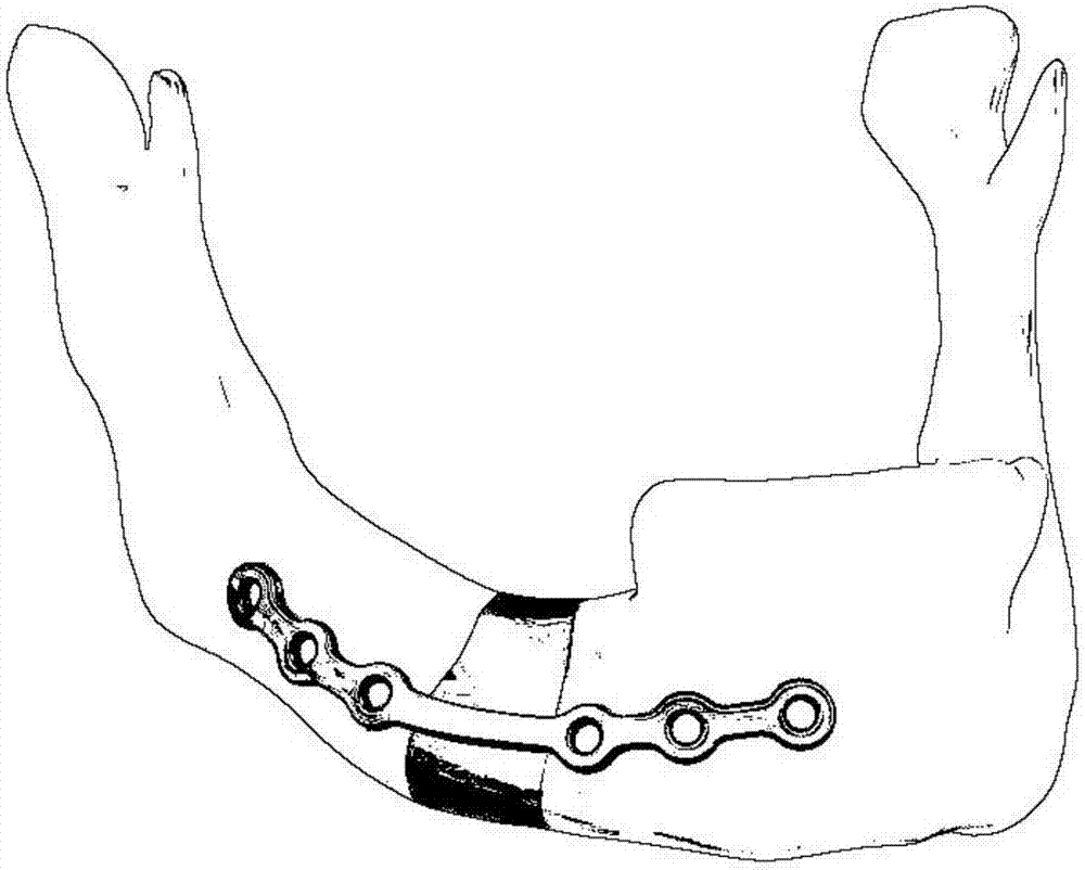 Manufacturing method of individualized prosthesis with porous structure