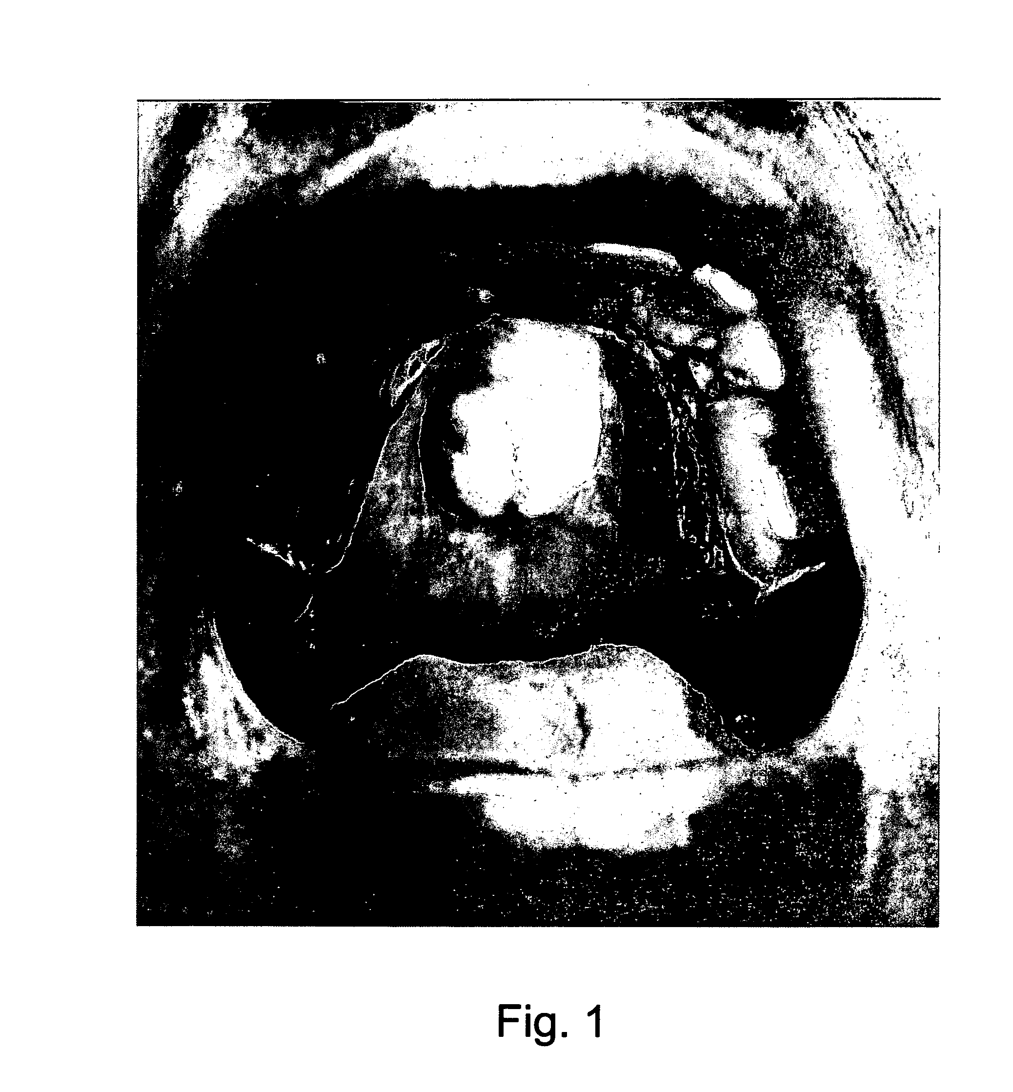 Palatal implant