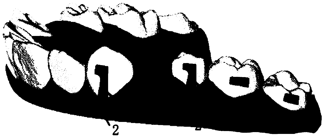 Anchorage traction composite accessory and invisible correction device