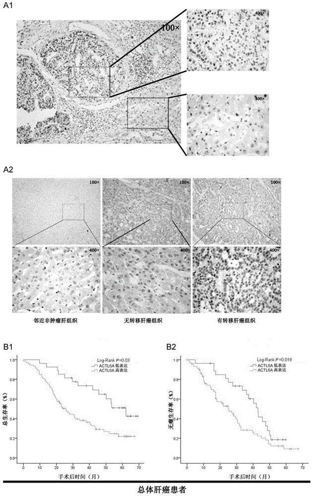 Application of ACTL6A gene to preparation of medicine for treating liver cancer or preventing relapse of liver cancer after surgery