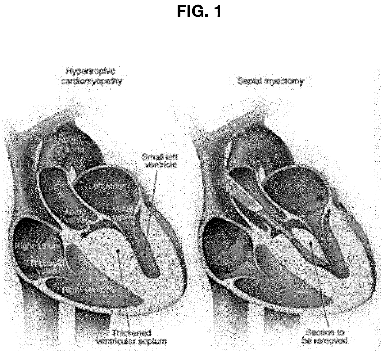 RF ablation catheter for septal reduction therapy having cooling effect