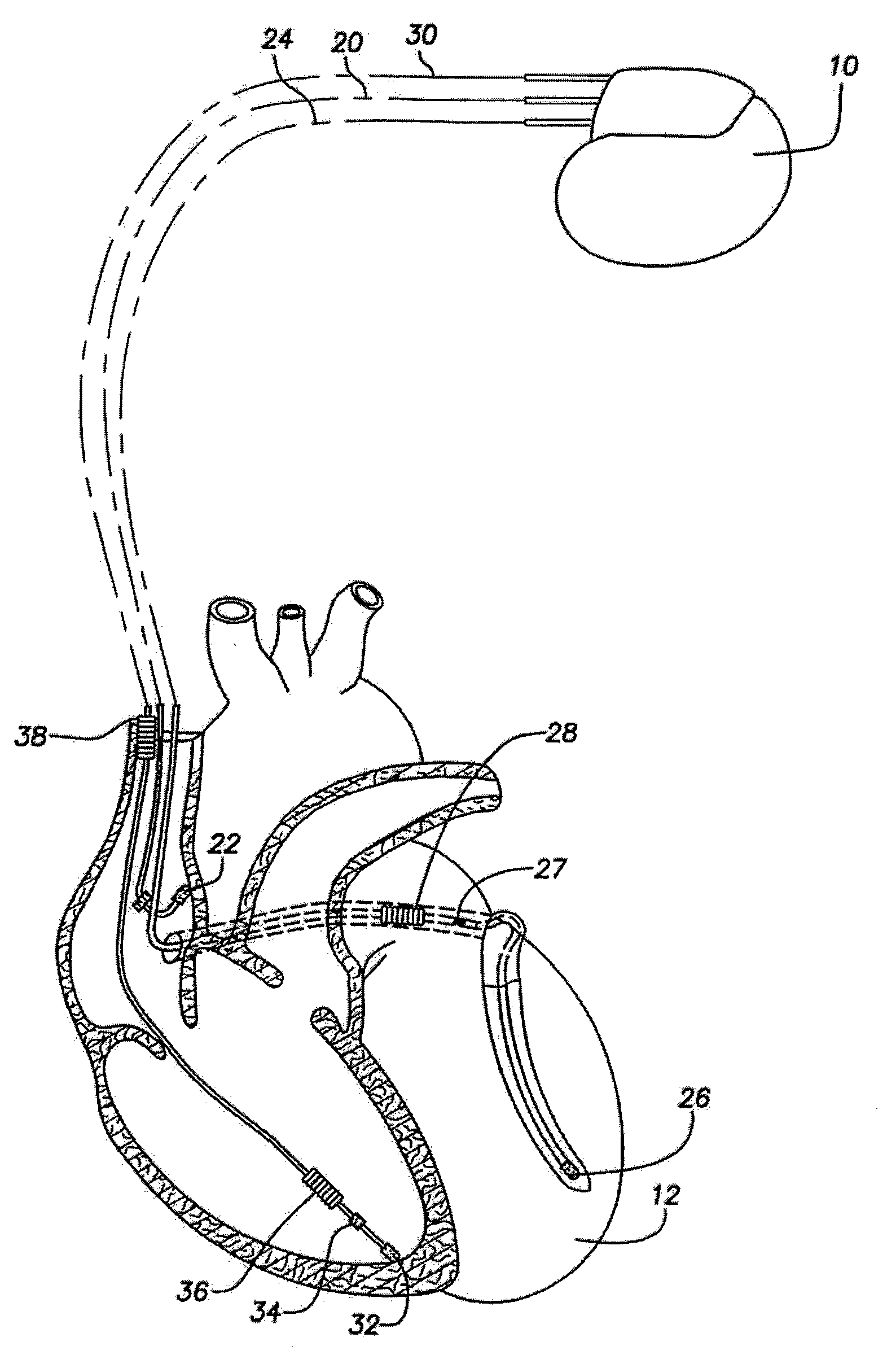 Monitoring short term fluctuations in pr intervals following premature ventricular contractions