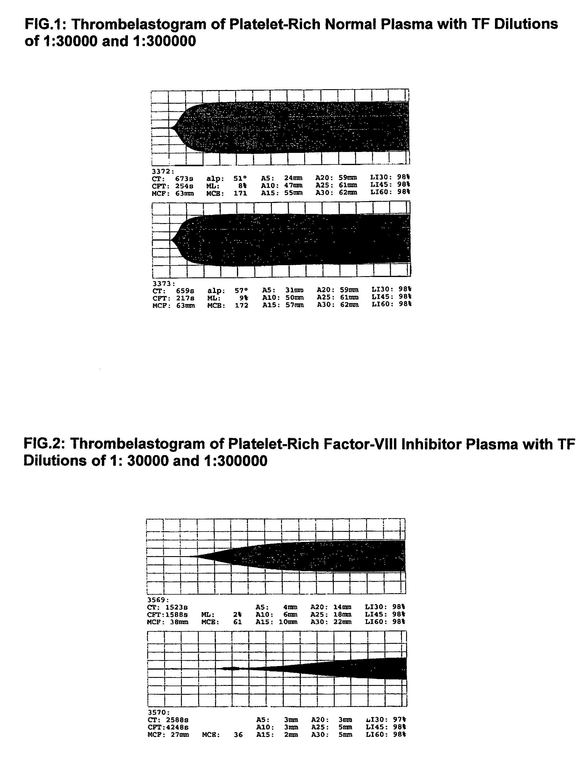 Thrombin-free composition containing freeze-dried, virally inactivated FXIa and serpins and/or kininogen