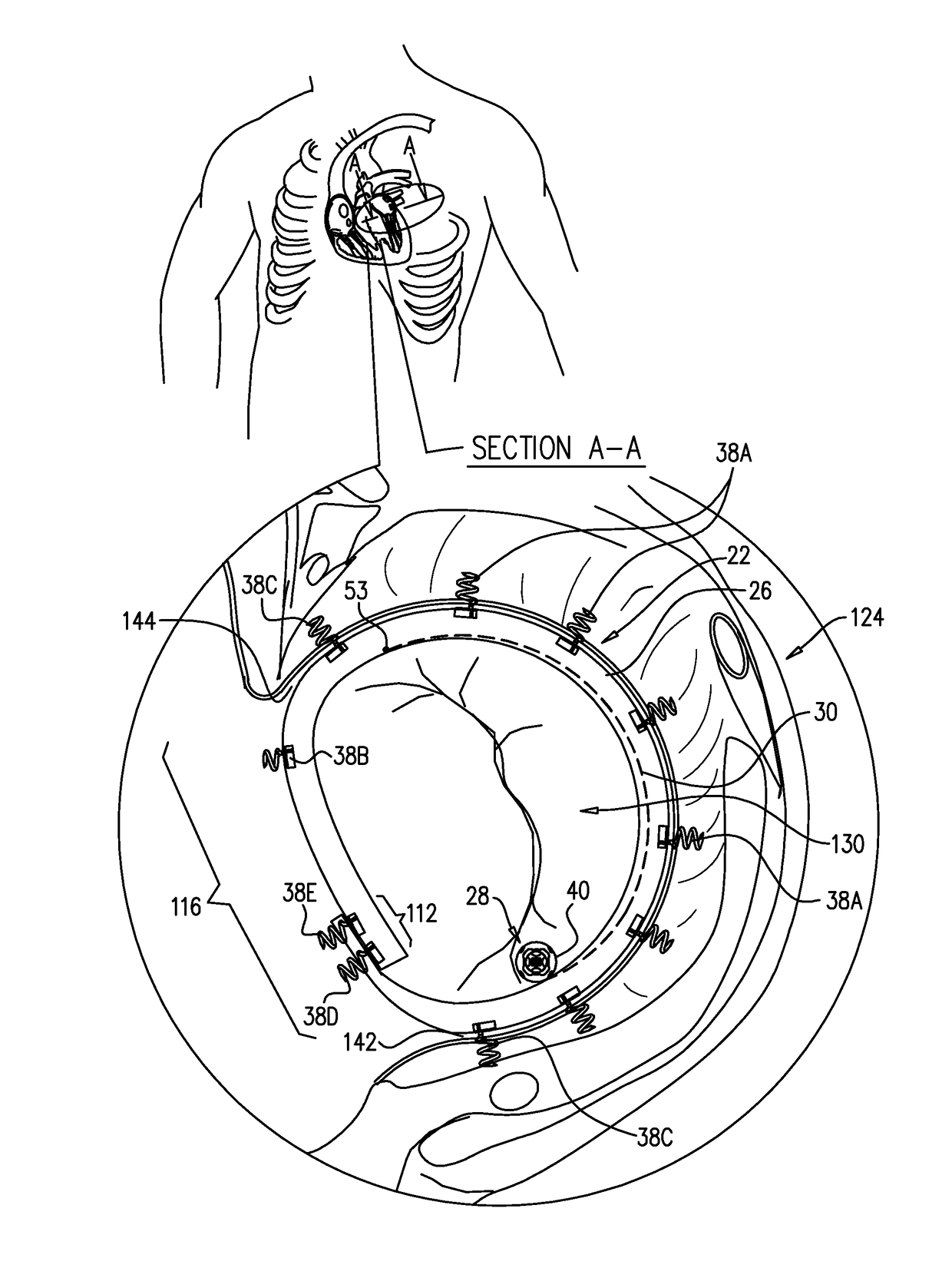 Closed band for percutaneous annuloplasty