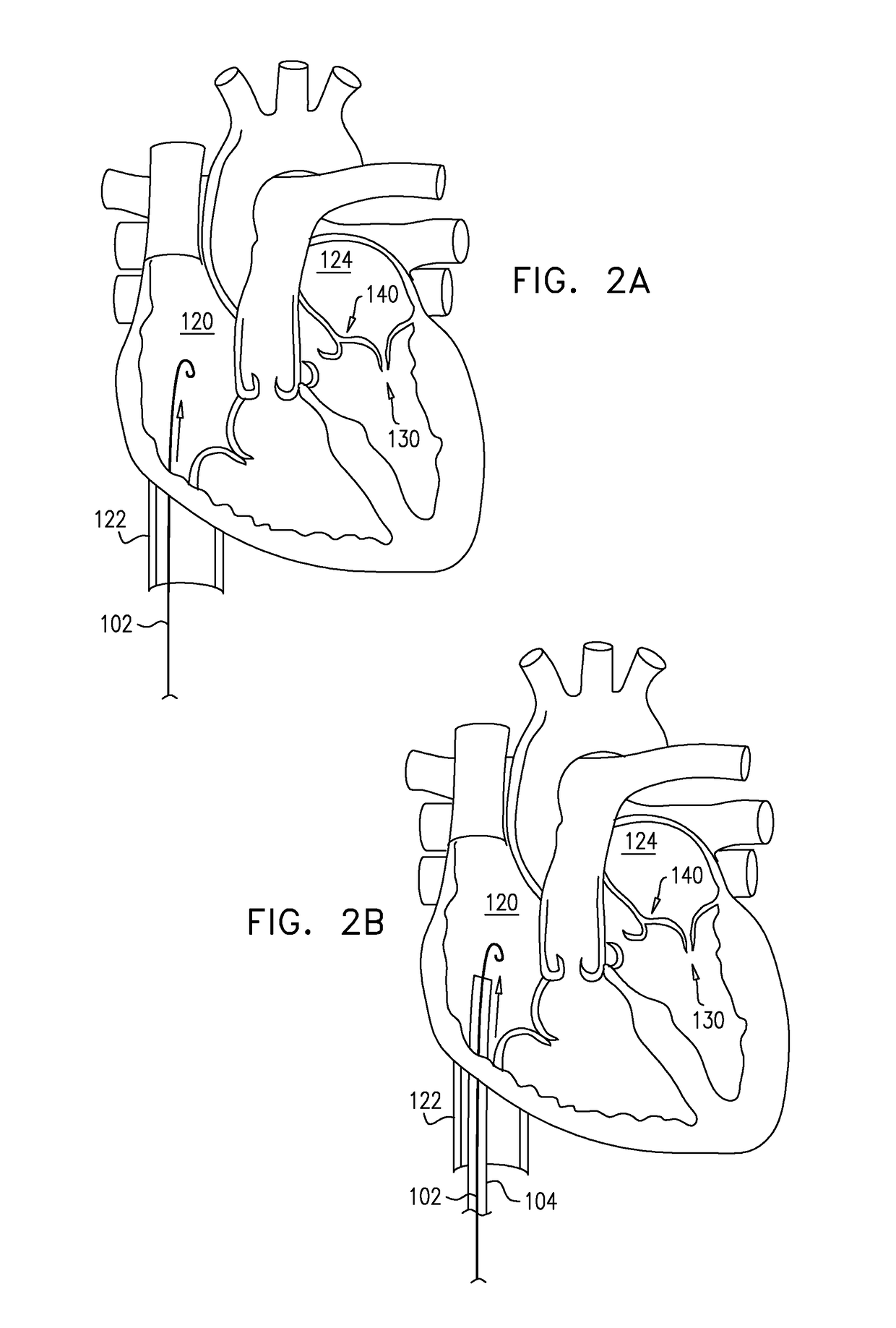 Closed band for percutaneous annuloplasty