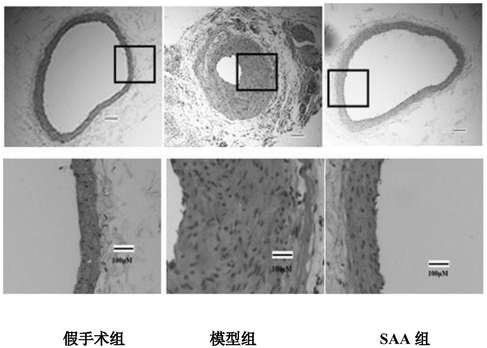 Application of salvianolic acid A in preparation of medicine for resisting tunica intima thickening, post-angioplasty restenosis and/or in-stent restenosis