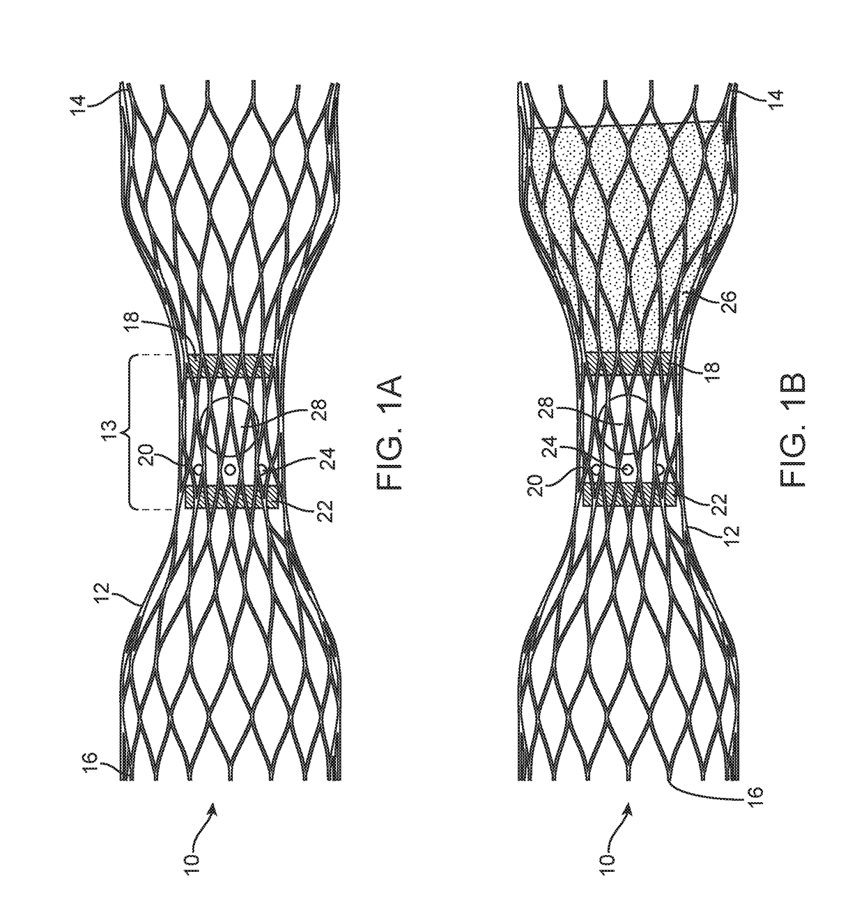 Venous valve prosthesis