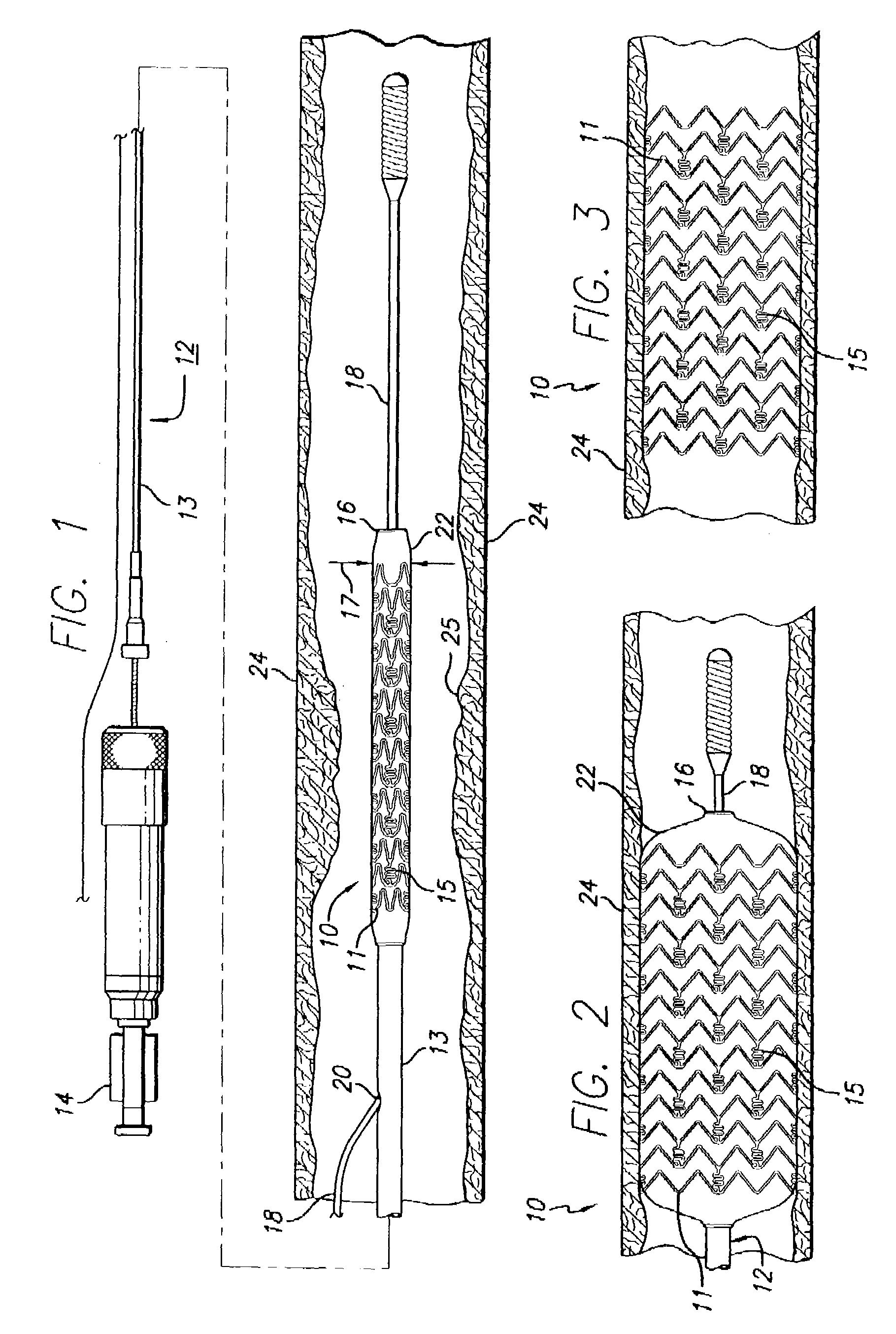 Drug-eluting stent and delivery system with tapered stent in shoulder region