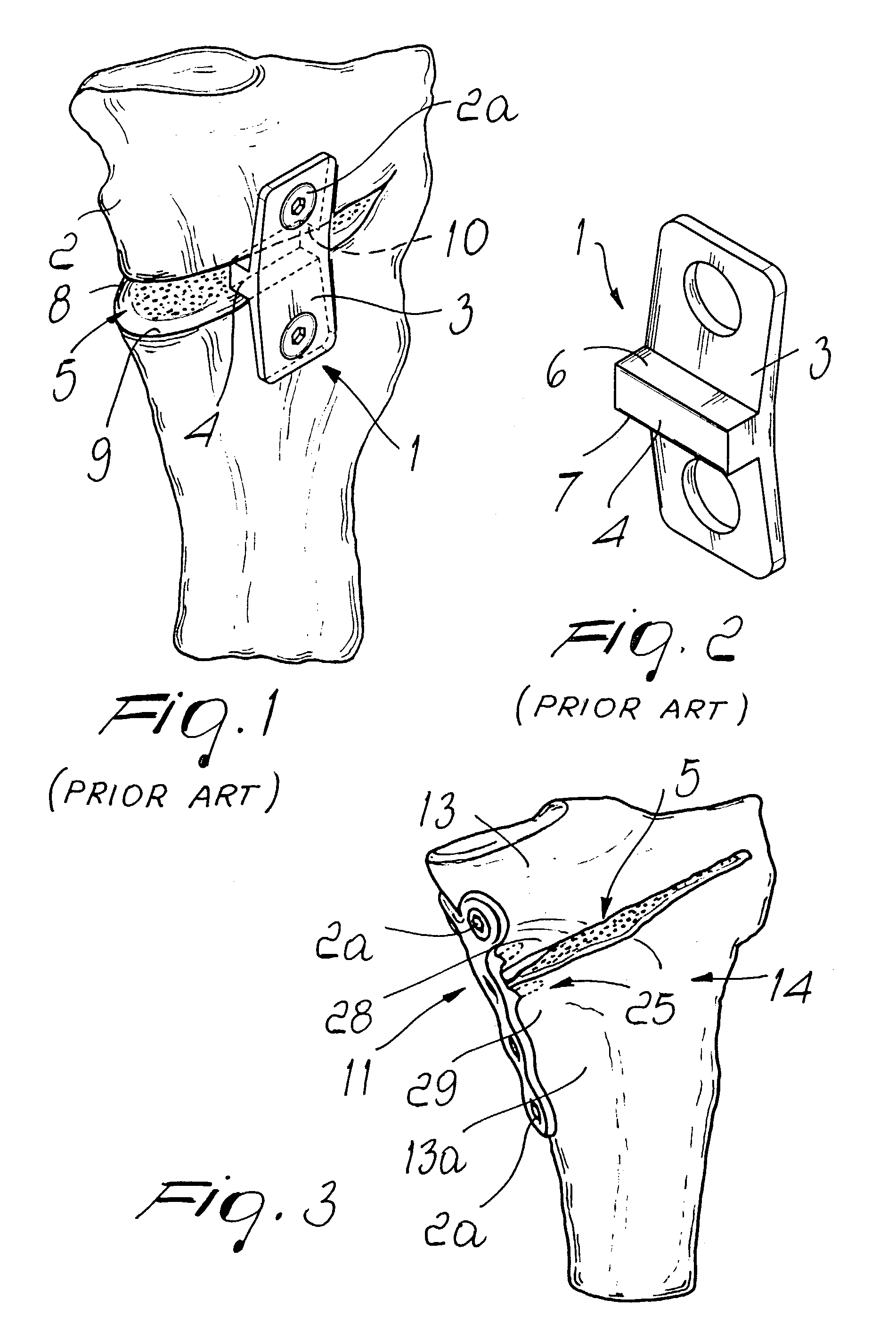 Stabilizing support for opening- and closing-wedge osteotomies