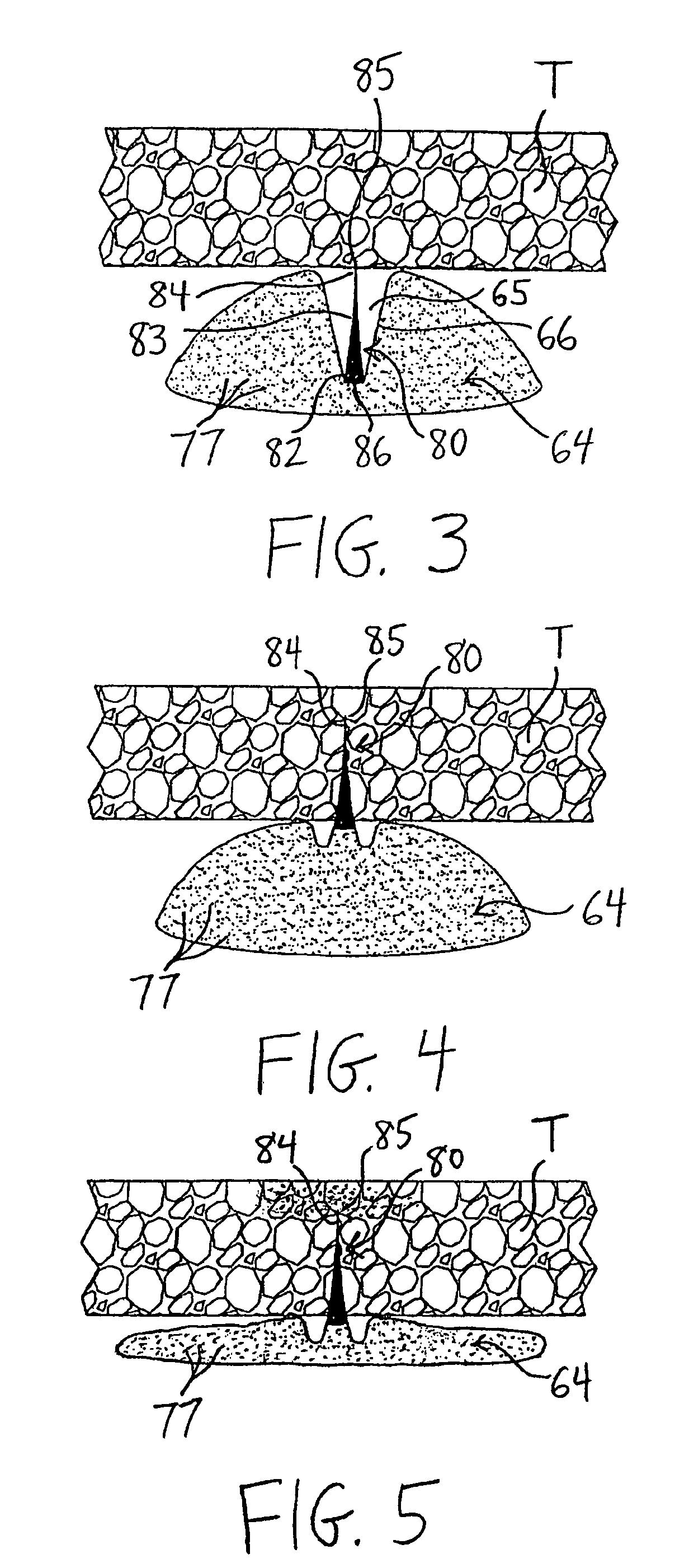 Balloon catheters having a plurality of needles for the injection of one or more therapeutic agents